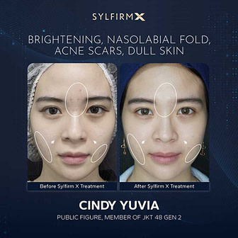 before-after-cindy-jkt