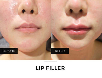 BA filler bibir 3