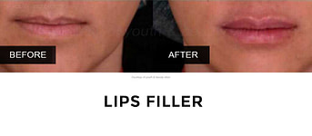 BA-filler-mine-5