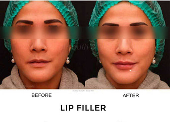 BA filler bibir 2
