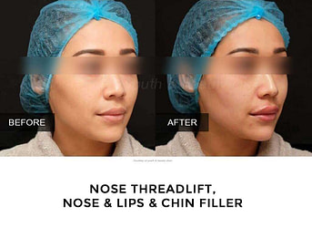 BA filler bibir 1