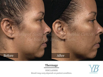 Thermage1