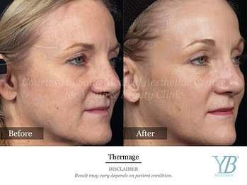 Thermage2