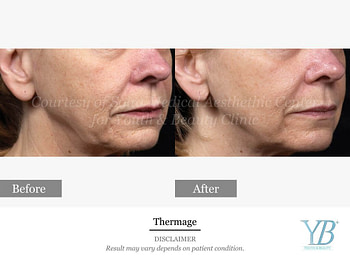 Thermage3