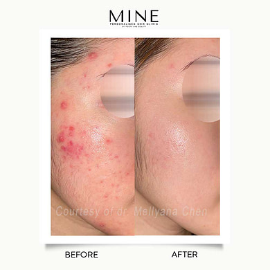 Acne3