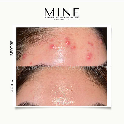 Acne2