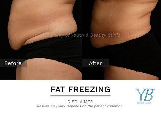 BA-YB-Fat-Freeze-min-1-1024x742