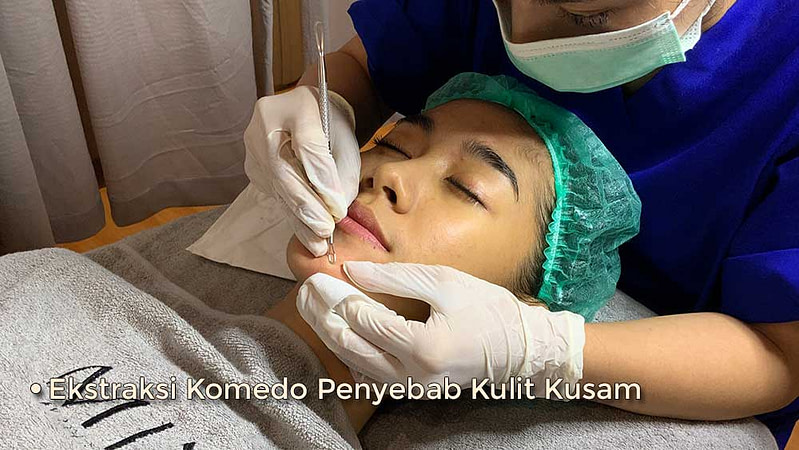 tahap-ekstraksi-komedo