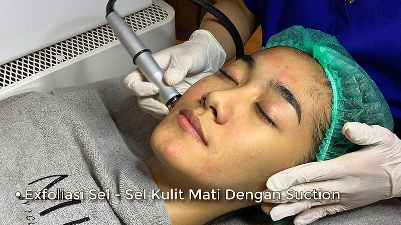 tahap-suction