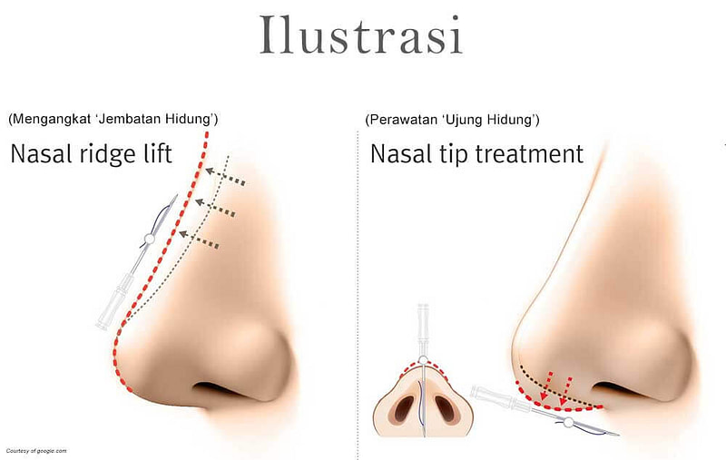 Nose-Threadlift-Illustration