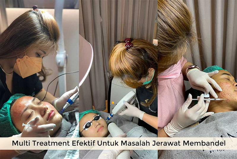 Multi-treatment-jerawat
