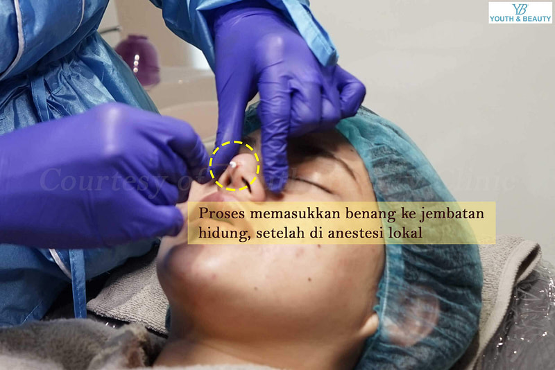 Proses-tanam-benang-hidung-ybc