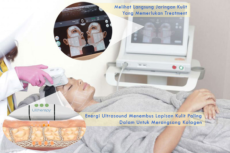 Proses-Ultherapy-YBC